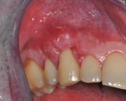 15 jours post-op 15 jours post-op