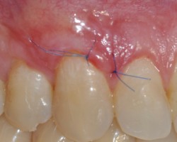 15 jours post-op 15 jours post-op